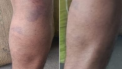 सिरोही. आबूरोड में मजदूर के साथ पुलिसकर्मियों पर मारपीट का आरोप Sirohi: Policemen are accused of assaulting a laborer in Abu Road