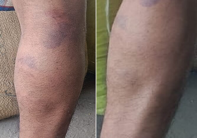 सिरोही. आबूरोड में मजदूर के साथ पुलिसकर्मियों पर मारपीट का आरोप Sirohi: Policemen are accused of assaulting a laborer in Abu Road